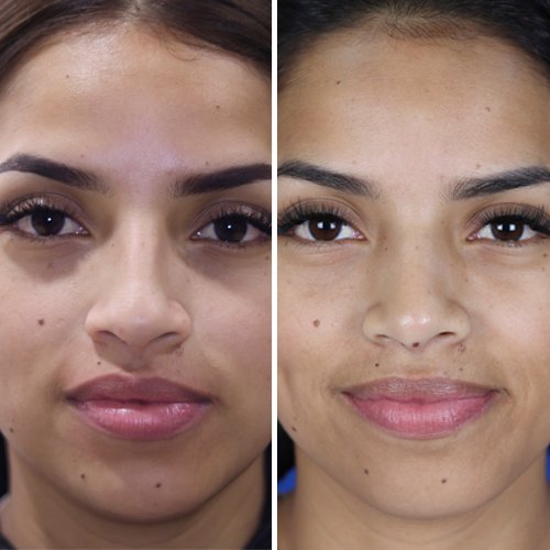 antes y despues de la rinoplastia alejandra - doctor roy acosta