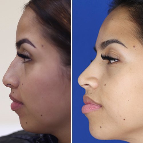 antes y despues de la rinoplastia alejandra - doctor roy acosta