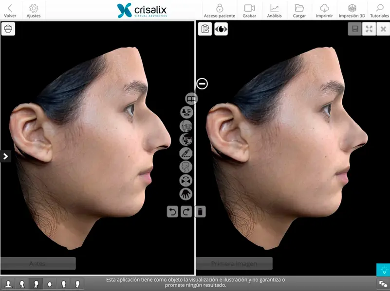 tecnologia crisalix para rinoplastia | doctor roy acosta