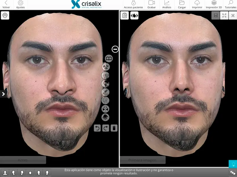 tecnologia crisalix para rinoplastia | doctor roy acosta